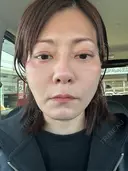 糸リフト 小倉美容外科/美容皮膚科 ビラビューティークリニック BEFORE サムネイル用