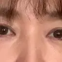 その他（目元） / ヒアルロン酸注入（鼻） / ヒアルロン酸注入（あご） / ボトックス（エラ・小顔） 湘南美容クリニック 札幌院 BEFORE サムネイル用