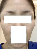 肌育注射（ジュベルックなど） / ジャルプロ LIFIX BEAUTY CLINIC BEFORE サムネイル用