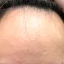 ボトックス（目尻） / ボトックス（額） / その他（目元） 共立美容外科 名古屋院 BEFORE サムネイル用