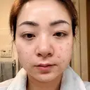 エレクトロポレーション / 光治療（フォトフェイシャルなど） トラスト美容クリニック 銀座院 BEFORE サムネイル用