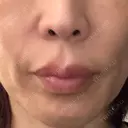 ソフウェーブ THE FIRST CLINIC 町田院 BEFORE サムネイル用
