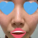ニキビ治療 / 美肌レーザー ウィルビークリニック 新宿院 BEFORE サムネイル用