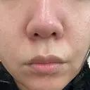 ピーリング（ニキビ・毛穴） ルラ美容クリニック 広島院 BEFORE サムネイル用