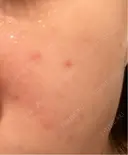ピーリング（ハリ・ツヤ） ジュエルクリニック 恵比寿院 BEFORE サムネイル用
