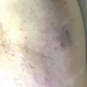 ワキ汗治療（レーザー） Fellez Clinic【フェルズクリニック】 BEFORE サムネイル用