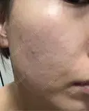 ピーリング（ハリ・ツヤ） / ルメッカ 大美会クリニック 天王寺院 BEFORE サムネイル用