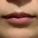 アートメイク（唇） TRUE DESIGN CLINIC BEFORE サムネイル用