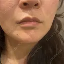 ハイフ（顔） Natural Skin Clinic 自由ヶ丘院 BEFORE サムネイル用