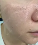 水光注射（ハリ・美肌） エトワールレジーナクリニック新宿院 BEFORE サムネイル用