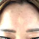 ボトックス（額） ルラ美容クリニック 郡山院 BEFORE サムネイル用