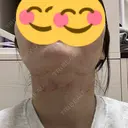 インモード おおかみ美容のクリニック 新宿院 BEFORE サムネイル用