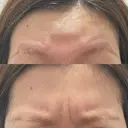 ワキ汗治療（ボトックス） / ボトックス（眉間） J CLINIC BEFORE サムネイル用