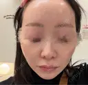 ピコレーザートーニング（美白・肝斑） / LDM・インテンスウルトラ Chloe Cheongdam Clinic （クロエチョンダムクリニック） BEFORE サムネイル用