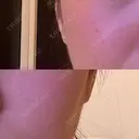 ハイフ（顔） / デンシティ DAILY SKIN CLINIC 新宿院 BEFORE サムネイル用