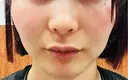 光治療（フォトフェイシャルなど） / ピーリング（ハリ・ツヤ） CZEN CLINIC 銀座院 BEFORE サムネイル用