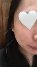 イオン導入 / 毛穴洗浄（ハイドラフェイシャルなど） RIN BEAUTY CLINIC BEFORE サムネイル用