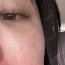 ルメッカ ルラ美容クリニック 岐阜院 BEFORE サムネイル用