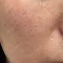 ダーマペン LE CLINIC BEFORE サムネイル用