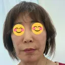 ヒアルロン酸注入（あご） / ヒアルロン酸注入（頬） / ヒアルロン酸注入（鼻翼基部） フローラクリニック BEFORE サムネイル用