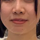 オンダリフト ルラ美容クリニック 渋谷本院 BEFORE サムネイル用