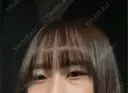 クマ治療 表参道ウィズ・クリニック BEFORE サムネイル用