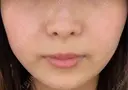 その他（輪郭） / 医療痩身（顔） / その他（肌） / RF（高周波）たるみ治療 / オンダリフト ライブリークリニック 船橋院 BEFORE サムネイル用