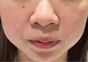 ほくろ・いぼ除去レーザー（肌） / ピコスポット Fellez Clinic【フェルズクリニック】 BEFORE サムネイル用