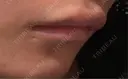 ボトックス（エラ・小顔） / ボトックス（口角） エスクリニック 恵比寿 BEFORE サムネイル用