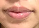 ヒアルロン酸注入（唇） 目白ホワイトクリニック BEFORE サムネイル用