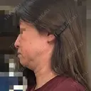 オンダリフト Wing clinic 豊中駅前院 BEFORE サムネイル用