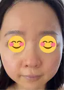 ニードルRF（ポテンツァなど） エトワールレジーナクリニック新宿院 BEFORE サムネイル用