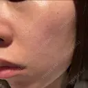 ルメッカ やさしい美容皮膚科・皮フ科　秋葉原院 BEFORE サムネイル用
