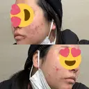 光治療（フォトフェイシャルなど） トラスト美容クリニック 銀座院 BEFORE サムネイル用