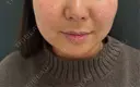 ヒアルロン酸注入（あご） eクリニック 那覇院 BEFORE サムネイル用