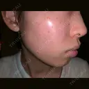 シミ取りレーザー / フォトRF 木本整形外科クリニック アンチエイジング美容外来センター BEFORE サムネイル用