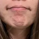 ボトックス（あご） / ボトックス（人中） 湘南美容クリニック 浜松院 BEFORE サムネイル用