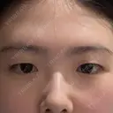上まぶたの脂肪取り / 眉下切開 新宿美容外科ネビュラクリニック BEFORE サムネイル用
