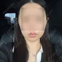 ボトックス（あご） / ヒアルロン酸注入（あご） / ボトックス（エラ・小顔） ルラ美容クリニック 千葉院 / ルラスキンクリニック 千葉院 BEFORE サムネイル用