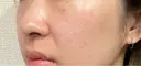 ルメッカ / LDM・インテンスウルトラ Chloe Cheongdam Clinic （クロエチョンダムクリニック） BEFORE サムネイル用