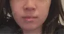 ボトックス（エラ・小顔） PRO CLINIC プロクリニック 銀座院 BEFORE サムネイル用
