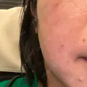 ピコスポット APスキンクリニック銀座 BEFORE サムネイル用