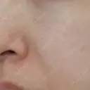 糸リフト / ヒアルロン酸注入（鼻翼基部） ルラ美容クリニック 宇都宮院 BEFORE サムネイル用