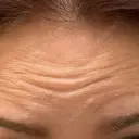 ボトックス（あご） / ボトックス（口角） / ボトックス（肩） / ボトックス（眉間） / ボトックス（額） / ボトックス（バニーライン） BIZENNクリニック【ビゼンクリニック】 BEFORE サムネイル用
