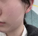 オンダリフト HAAB CLINIC 池袋院 BEFORE サムネイル用