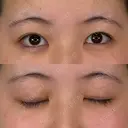 二重埋没 アリエル美容クリニック 横浜院 BEFORE サムネイル用