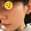 肌育注射（ジュベルックなど） メディアージュクリニック 大阪梅田院 BEFORE サムネイル用