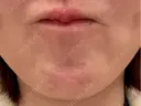 ボトックス（あご） / ボトックス（眉間） / ボトックス（額） Belle Via Clinic BEFORE サムネイル用