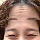 ボトックス（あご） / ボトックス（目尻） / ボトックス（額） 湘南美容クリニック 千葉センシティ院 BEFORE サムネイル用