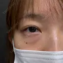 クマ治療 ネビュラクリニック 京都院 BEFORE サムネイル用